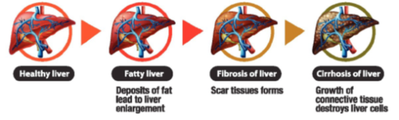 Graphic showing the stages of liver disease, from healthy liver to cirrhosis.