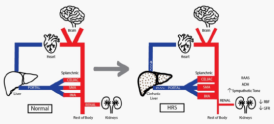 Cartoon showing the difference in blood flow between a normal liver and cirrhotic liver. The main difference is backup of blood flow, causing portal hypertension.