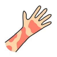cartoon of a forearm with red patches on the skin