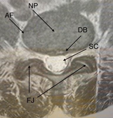 MRI of Lumbar Disk between L4-L5 with Bulge and Facet Joints